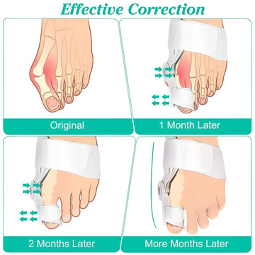 Bunion Splint and Big Toe Straightener Orthopedic Hallux Valgus Corrector for Foot Pain Relief and Pedicure Care White Medical Grade Support