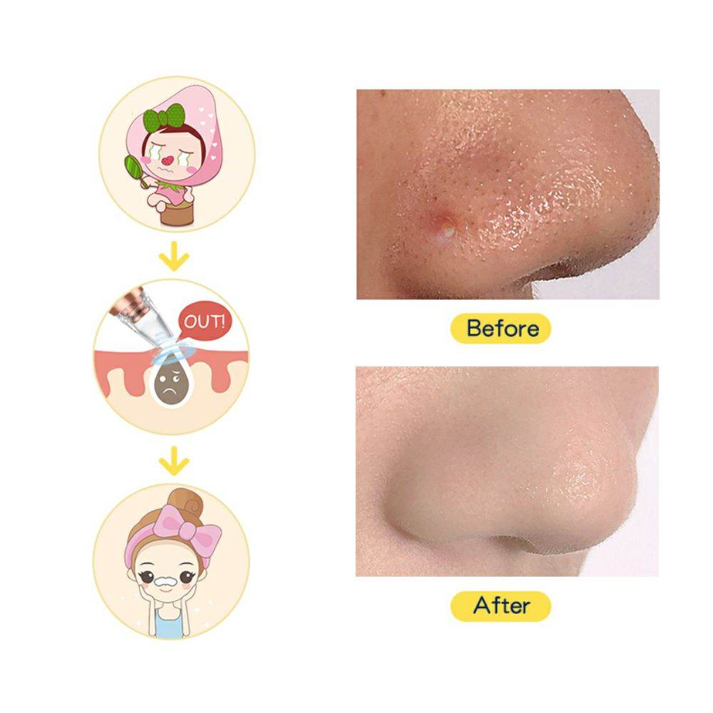 Multi-Functional Rechargeable 6 Suction Heads Blackhead Whitehead Extractor Remover Device Suction Tool - Al-Raheem Imports