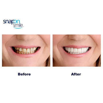 Snap On Smile Custom Fit Perfect Smile Veneers White Instant Fake Tooth Cover in 3 Easy Steps